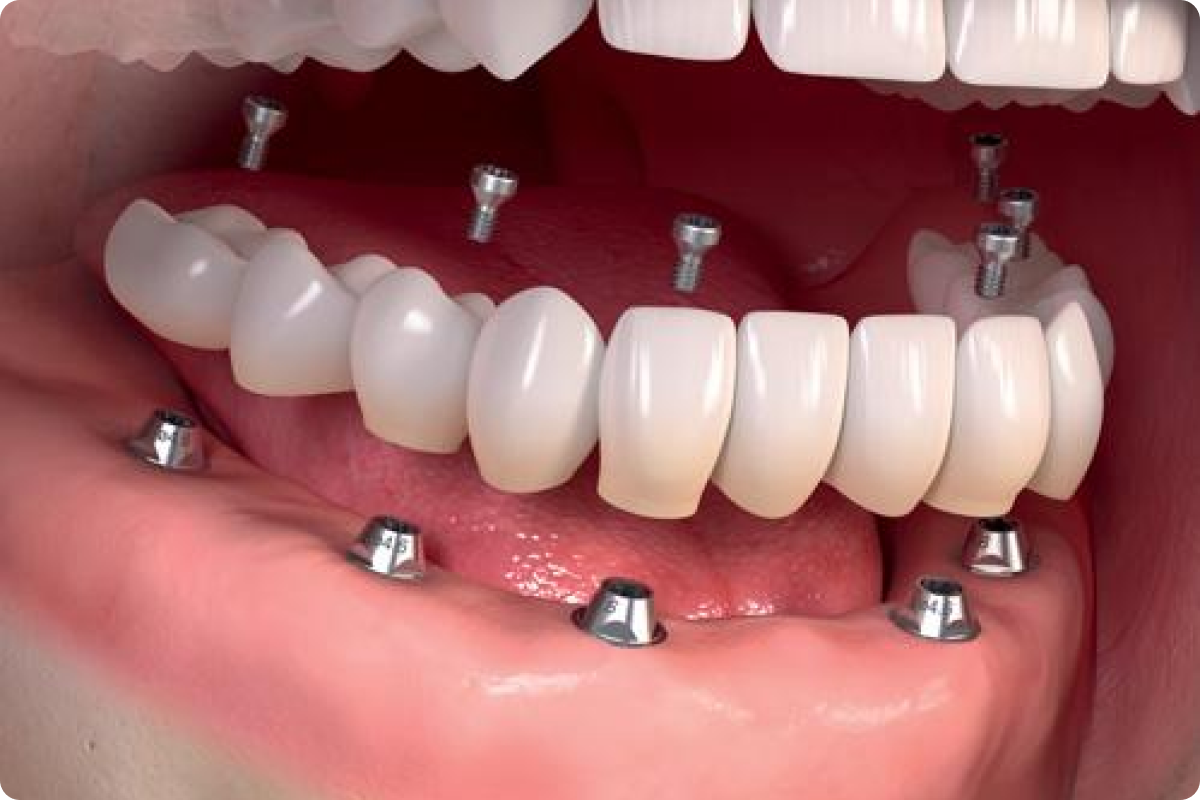 All Teeth Implant in Single Day