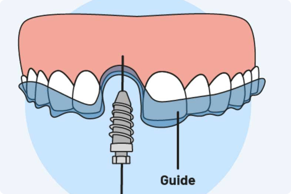 Digital Guided Implant Surgery