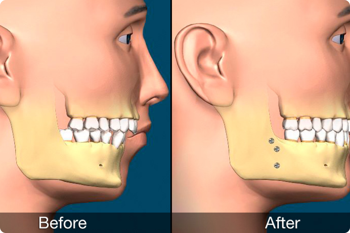 Jaw Surgery