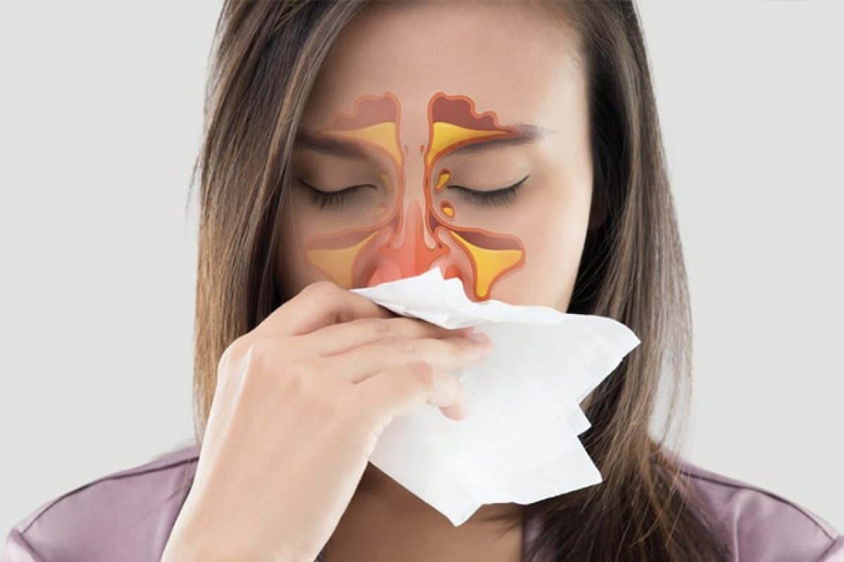 Sinus Problems Management