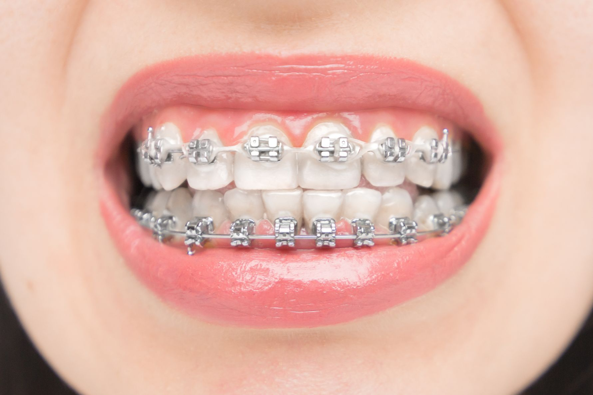 Treatment of Malaligned Teeth